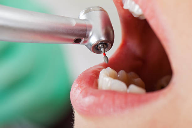 Best Emergency Root Canal Therapy in Washington, NC